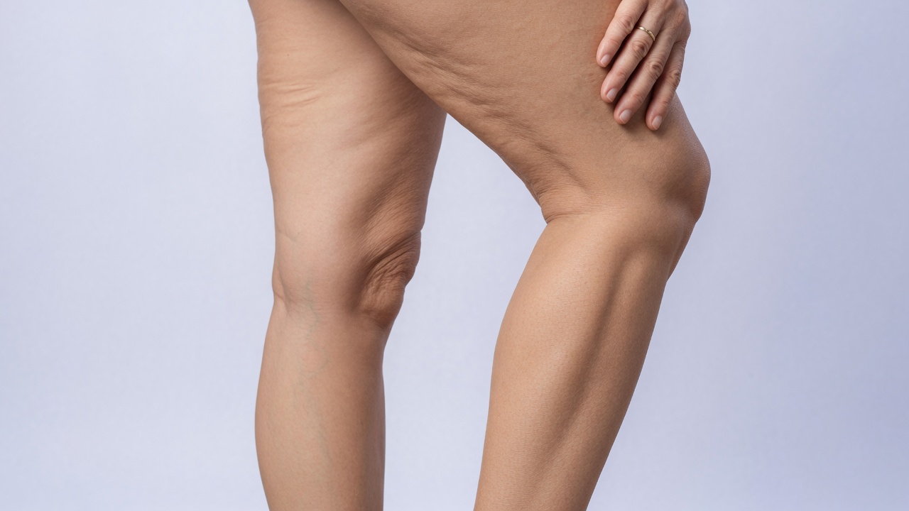Editorial photograph related to Skin Laxity: How do you fix skin laxity?